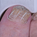 Toe with nail crumbling