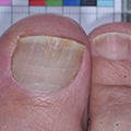 Toe with nail crumbling